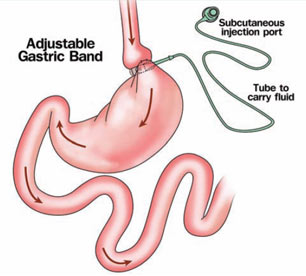 Laparoscopic adjustable gastric banding Singapore General Hospital
