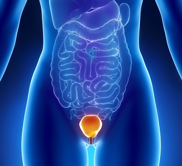 Bladder cancer: What it is