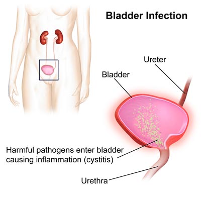 bladder infection that causes urinary tract infection
