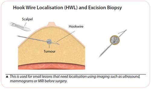 hook wire localisation for breast cancer