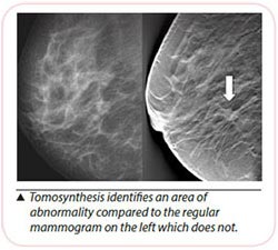 tomosynthesis of breast cancer