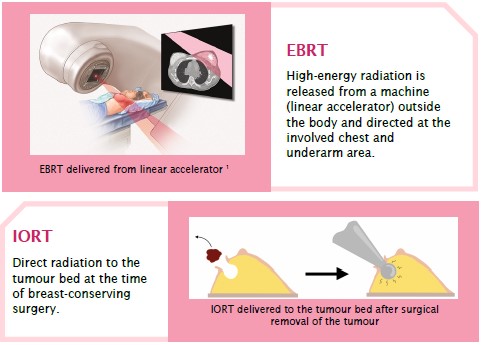 radiation therapy for breast cancer