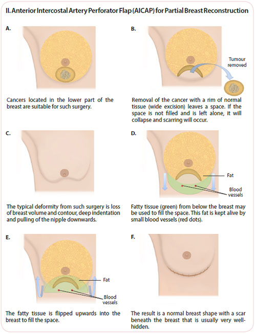 anterior intercostal artery perforator flap for breast cancer