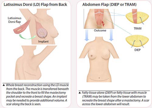 different types of flap reconstructions for breast cancer