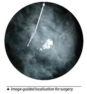 image guided localisation for breast cancer surgery