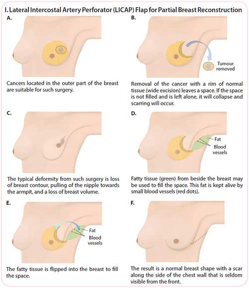 lateral intercostal artery perforactor flap for breast cancer