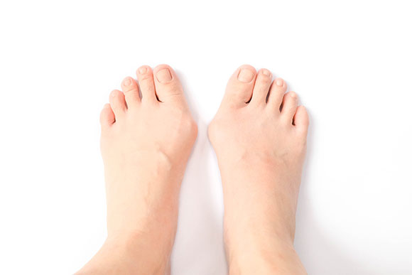 Bunion (Hallux Valgus) conditions and treatments - SingHealth
