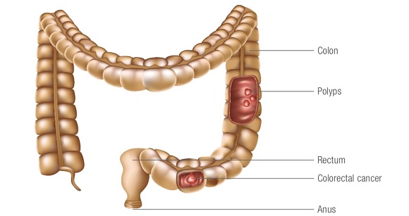 diagram of colorectal cancer