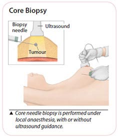 core needle biopsy for breast cancer