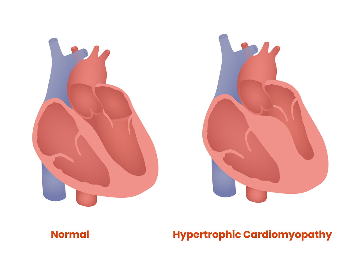 Hypertrophic cardiomyopathy - SingHealth