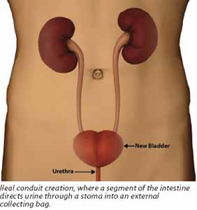 Urinary stoma (ileal conduit) for bladder cancer