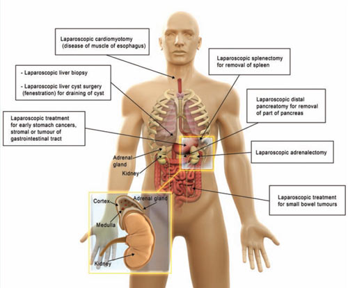 Other Gastrointestinal MIS Procedures Singapore General Hospital
