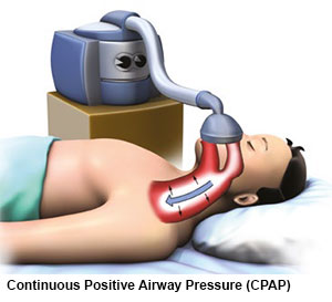 continuous positive airway pressure therapy for obstructive sleep apnoea