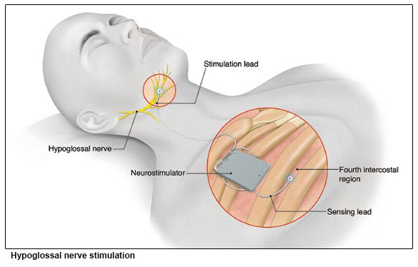 hypoglossal nerve stimulation for obstructive sleep apnoea