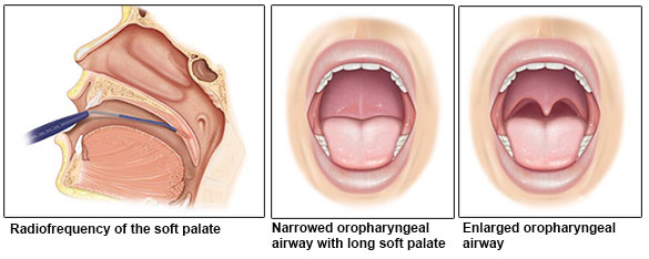 palatal surgery for obstructive sleep apnoea