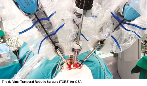 robotic surgery for people with obstructive sleep apnoea
