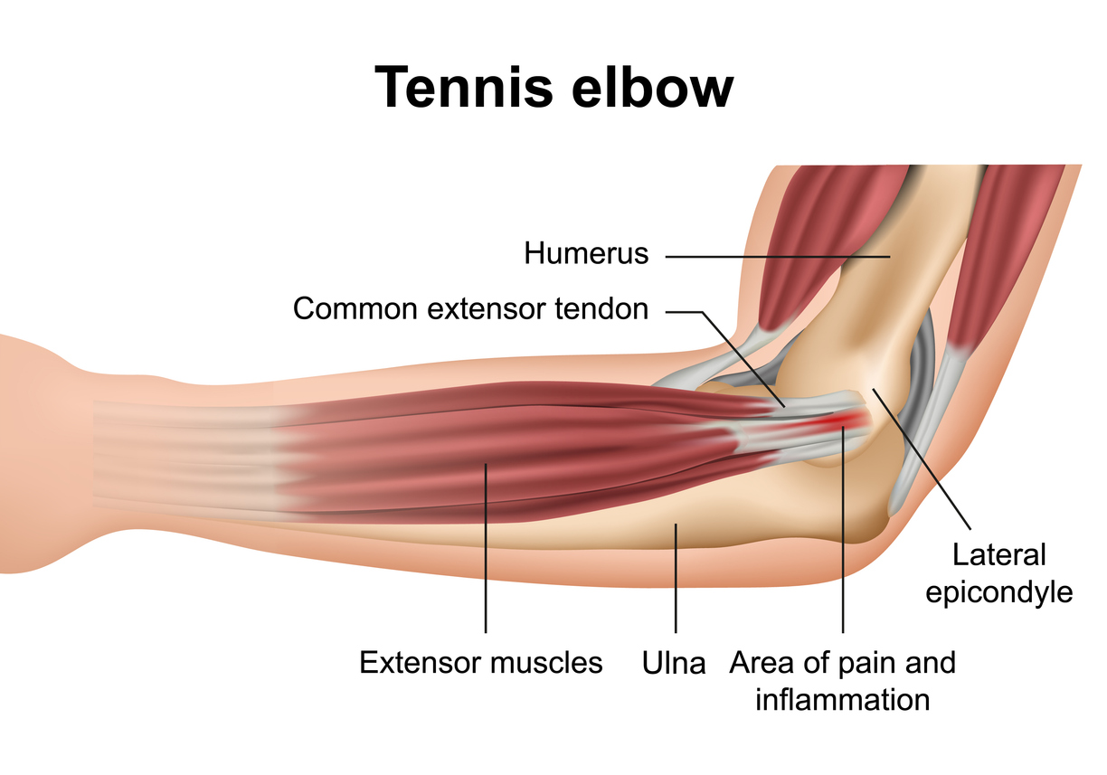 Tennis elbow (lateral epicondylitis) - SingHealth