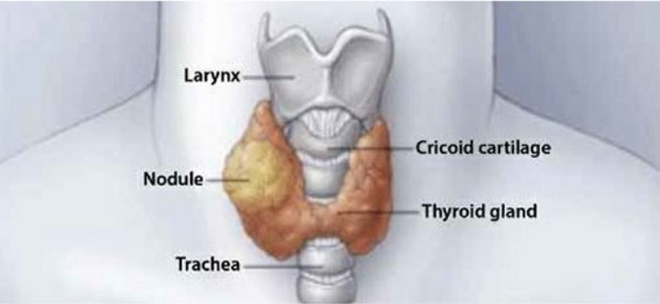 parts of the neck, with thyroid cancer