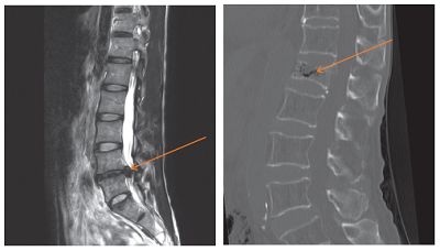 lower back pain causes - slipped disc or spine fracture