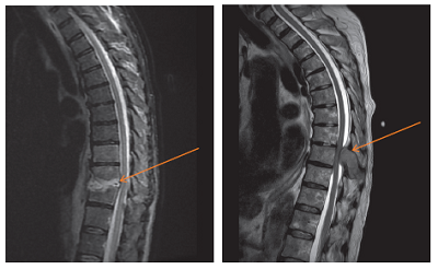 lower back pain causes - spine infevtion or tumour in the spine