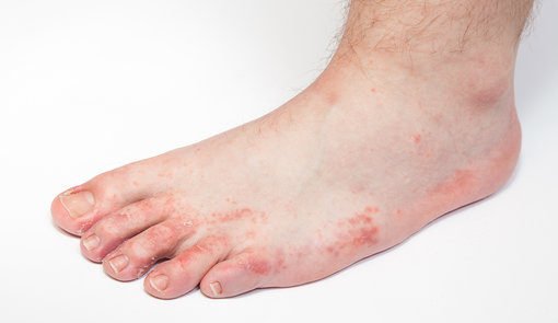 Athlete’s-Foot